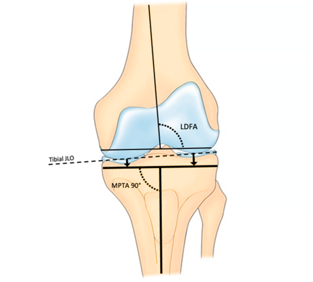 Total Knee Replacement (Arthroplasty) – Melbourne Orthopaedic Clinic